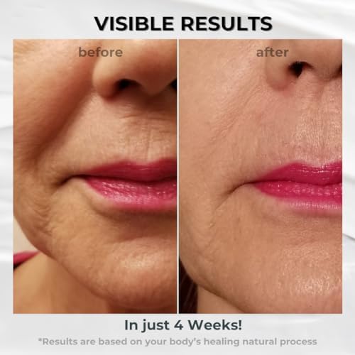 Anti-Aging Upper Lip Wrinkle Treatment - Reduce Mild to Deep Vertical Lip Lines, Wrinkles and Prevent Lipstick Bleeding (0.5 oz)