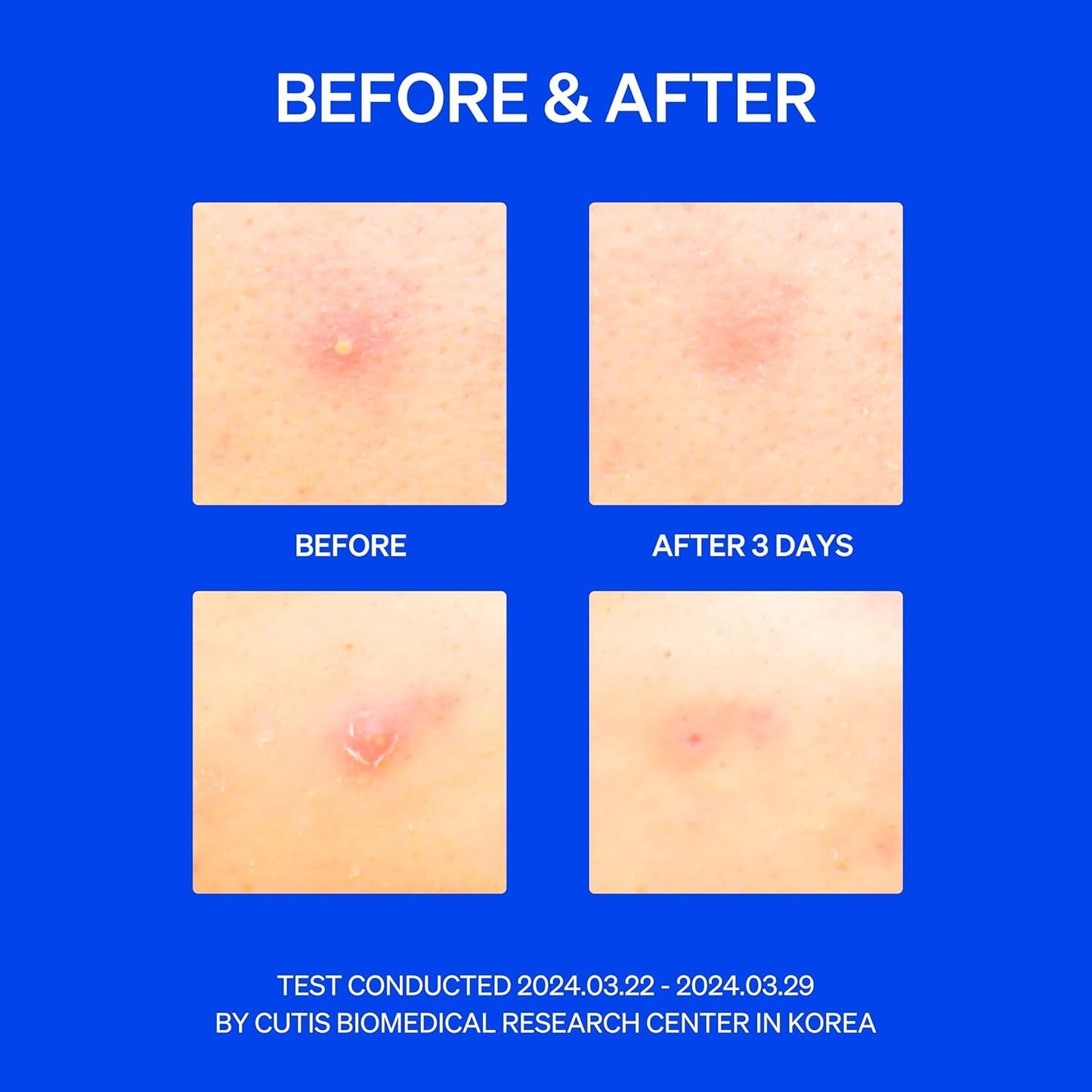 RIGHT AWAY Microtip Hydrocolloid Acne Pimple Patch for Early Stage Zits and Hidden Blemish (8 Patches) Microdart Patch