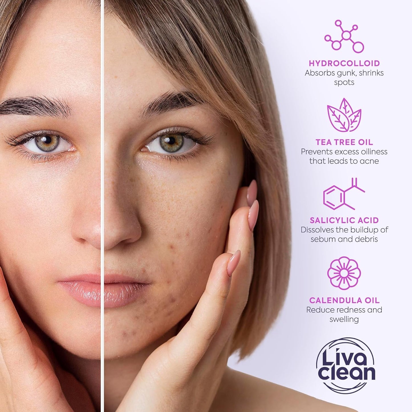 LivaClean 330 CT Pimple Patches for Face w/Salicylic Acid, Tea Tree Oil & Calendula Oil - Four Sizes - Pimple Patch, Hydrocolloid Patch, Acne Patches for Face