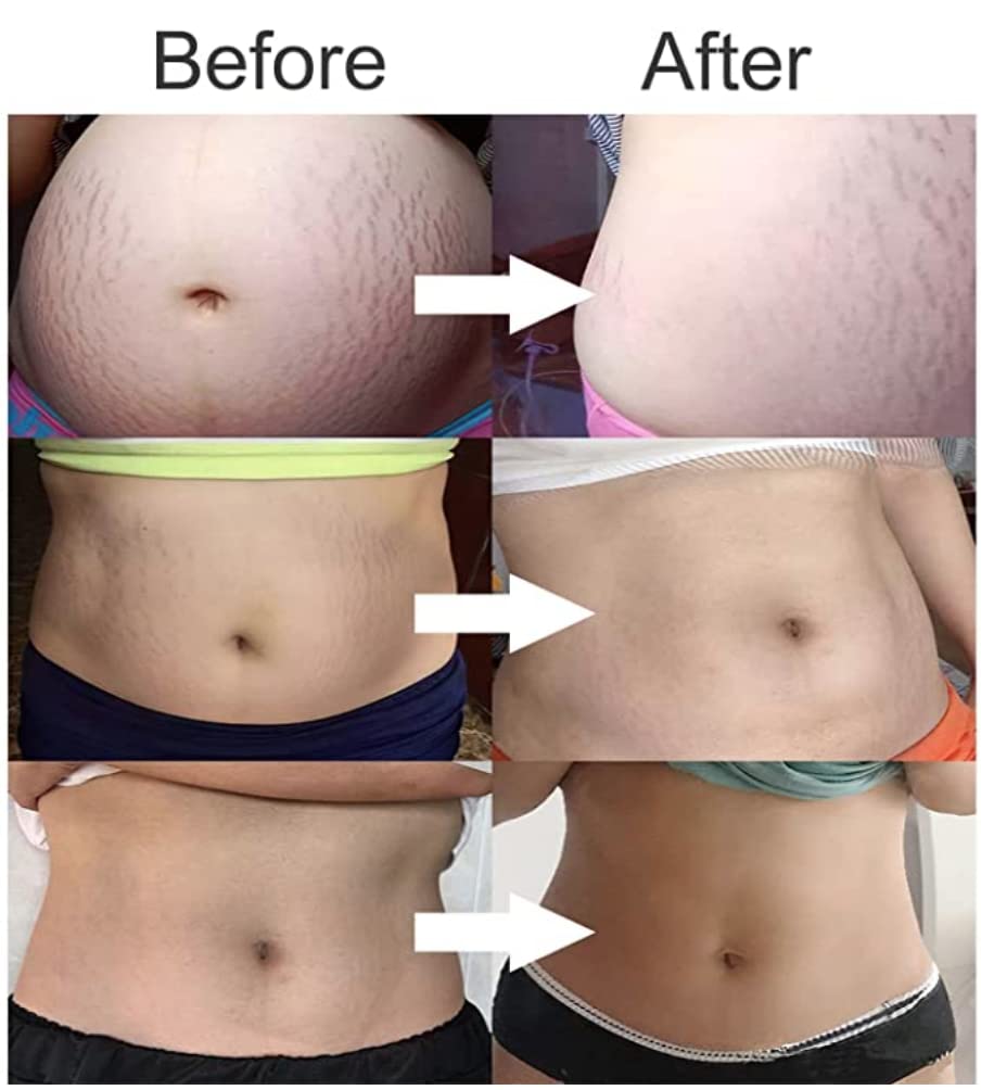 Stretch Mark Cream 120g/4 oz Stretch Marks Lotion Pregnancy Creams, Belly Butter Pregnant Women Stretch Mark Removal Treatment, Maternity Skin Care Moisturizer Scar Wrinkle Prevention