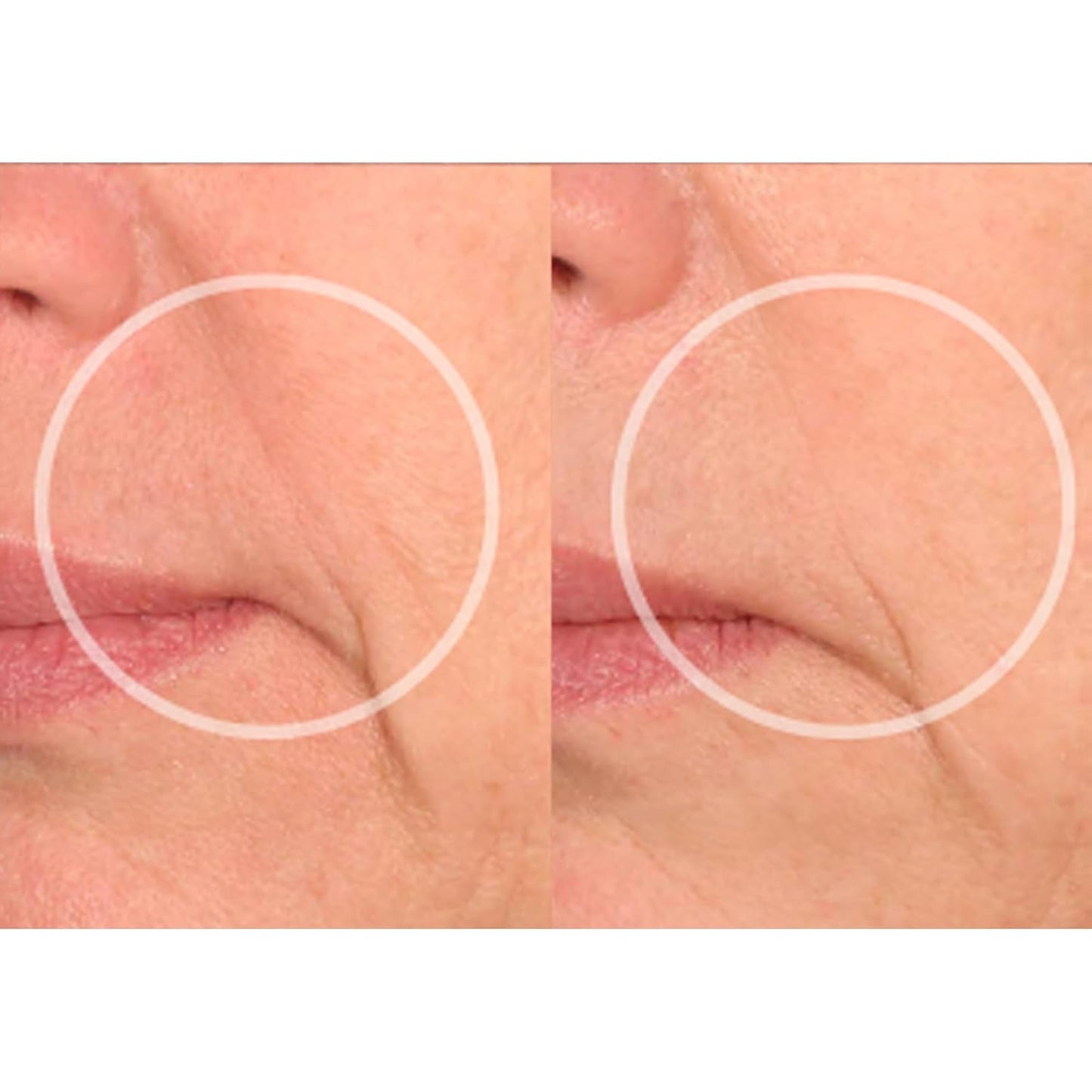 SiO Beauty Eye & Smile Lift - Eye & Smile Anti-Wrinkle Patches 2 Week Supply - Overnight Smoothing Silicone Patches for Wrinkles and Fine Lines