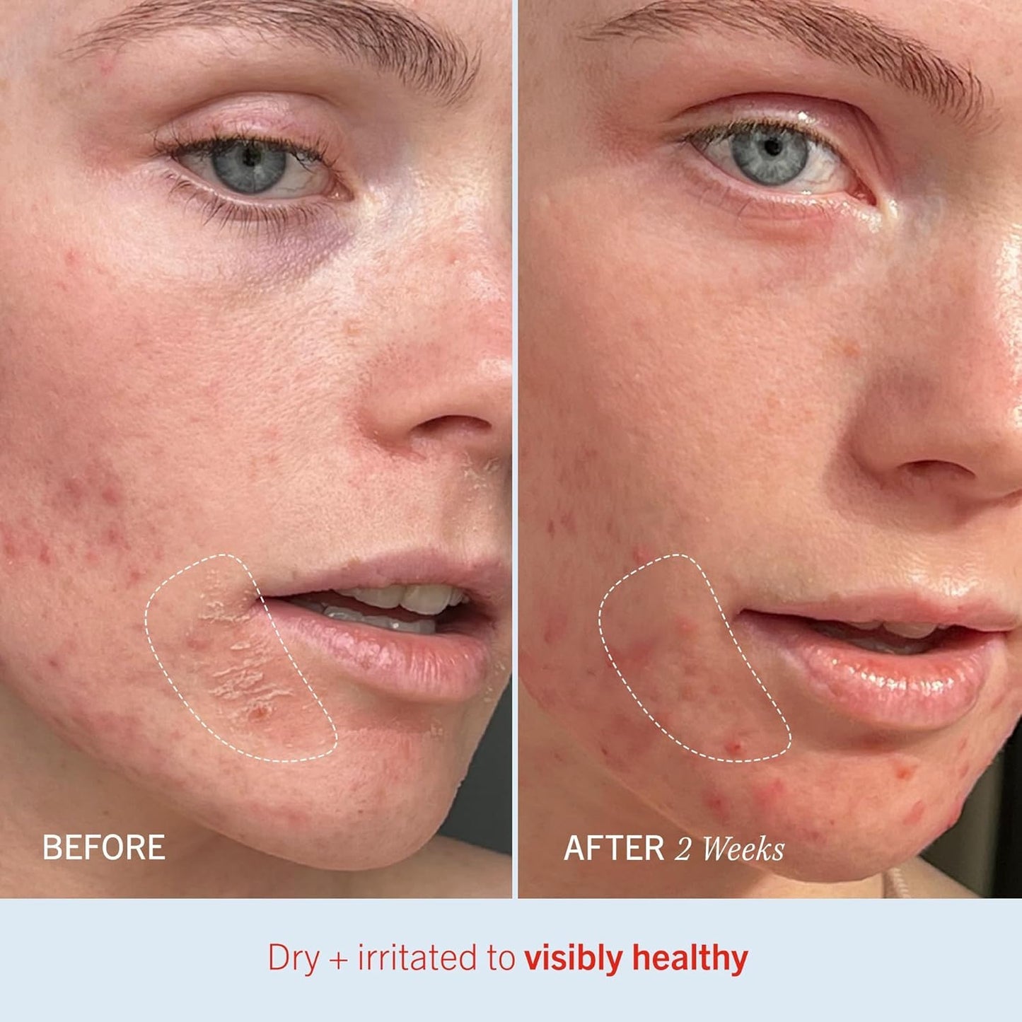 First Aid Beauty - Ultra Repair Cream, Intense Hydration Whipped Colloidal Oatmeal, Clinically Proven to Strengthen Skin Barrier & Help Relieve Eczema, Face & Body Moisturizer, 14oz Fresh Strawberry