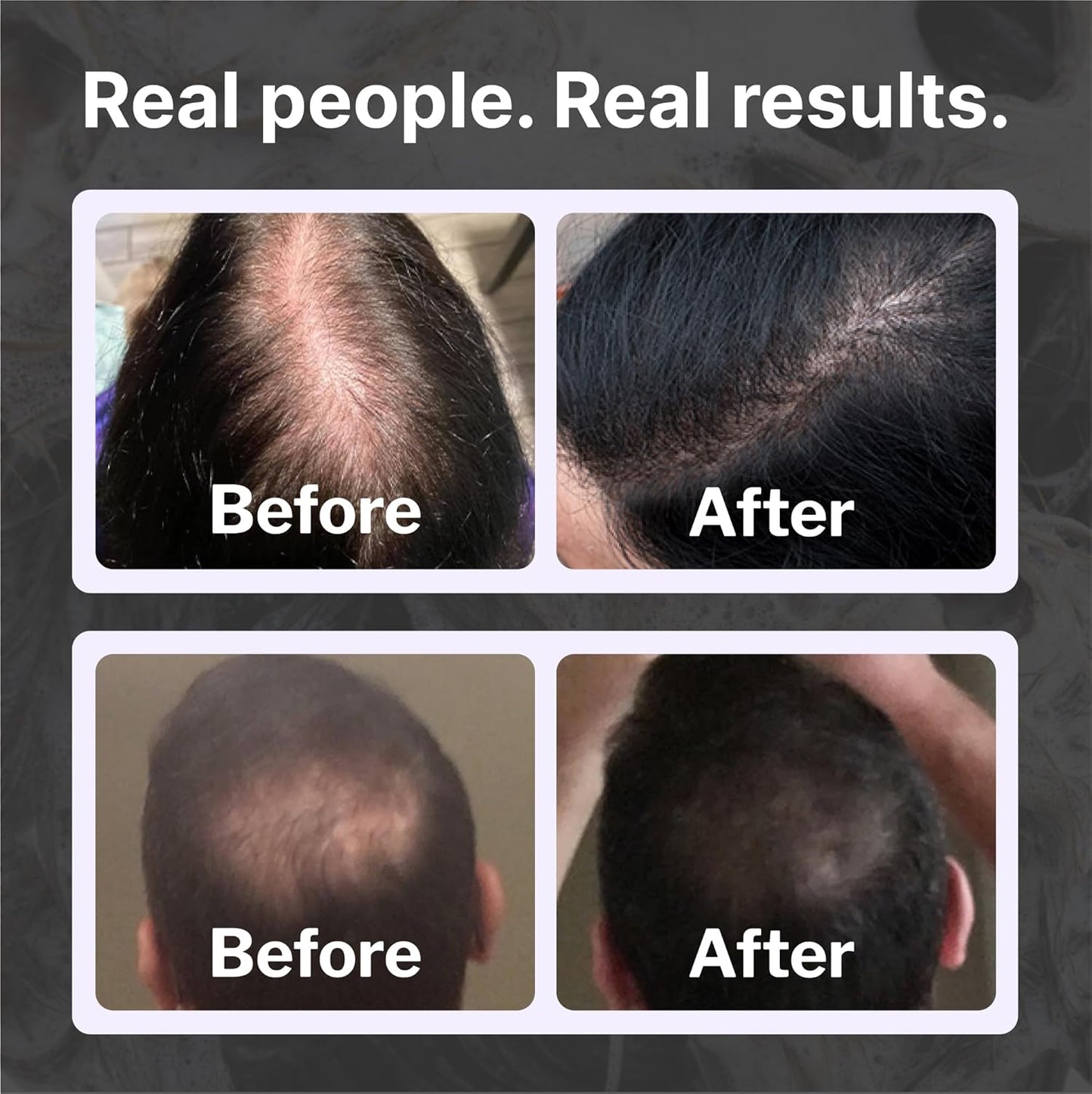 Shapiro MD Hair Growth Experts Natural Hair Kit for Thicker, Fuller, Healthier Looking Hair - Including Shampoo, Conditioner and Leave-In Daily Foam (1 Month Supply)