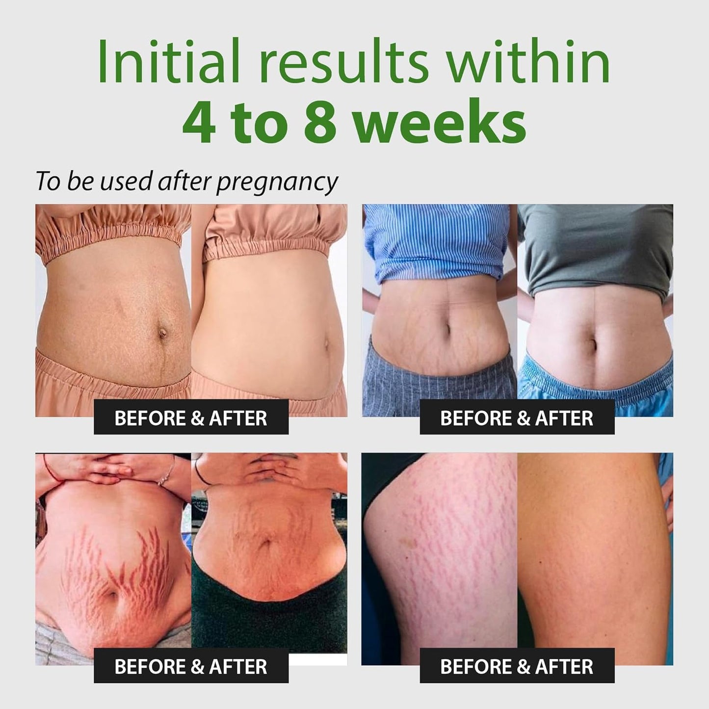 Abera Ovela Maternity Stretch Mark Cream for Pregnancy and Weight Fluctuations, Stretch Mark Treatment Pregnancy Must Haves, Deep Stretch Mark Removal, All Skin Types, 1.69 fl oz